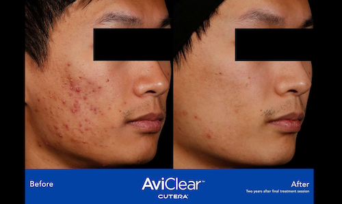 acne treatment before after oakville mississauga